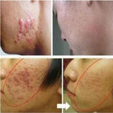 Acne Scar Removal Cream