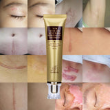 Acne Scar Removal Cream